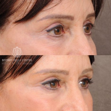 Beverly Hills Center Female Patient Before and After AuraLyft™, Temporal Brow Reset, and Fat Grafting