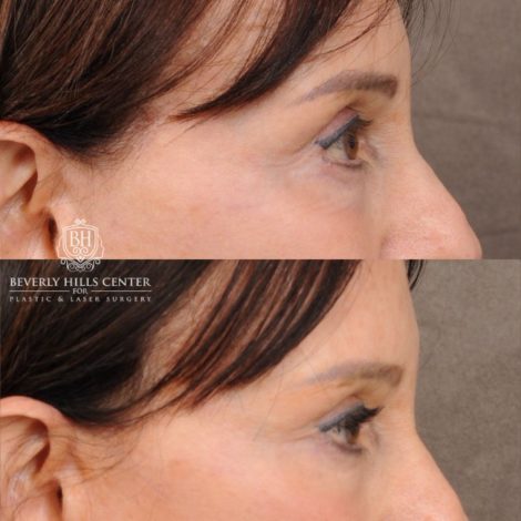 Beverly Hills Center Female Patient Before and After AuraLyft™, Temporal Brow Reset, and Fat Grafting
