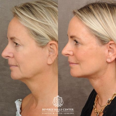 Beverly Hills Center Female Patient Before and After AuraLyft, Cupid Lift® Corner Lift, Upper & Lower Blepharoplasty, Temporal Brow Reset, Fat Grafting, Earlobe Reduction