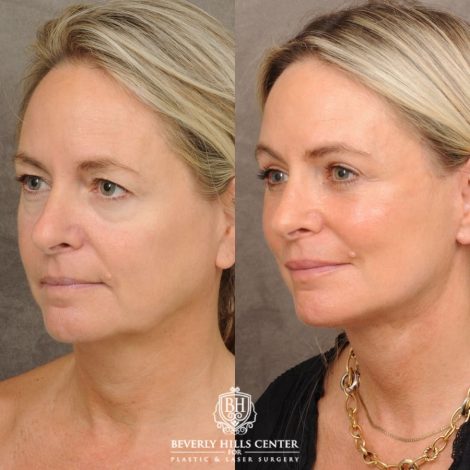 Beverly Hills Center Female Patient Before and After AuraLyft, Cupid Lift® Corner Lift, Upper & Lower Blepharoplasty, Temporal Brow Reset, Fat Grafting, Earlobe Reduction