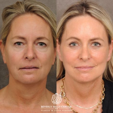 Beverly Hills Center Female Patient Before and After AuraLyft, Cupid Lift® Corner Lift, Upper & Lower Blepharoplasty, Temporal Brow Reset, Fat Grafting, Earlobe Reduction