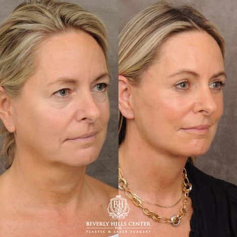 Beverly Hills Center Female Patient Before and After AuraLyft, Cupid Lift® Corner Lift, Upper & Lower Blepharoplasty, Temporal Brow Reset, Fat Grafting, Earlobe Reduction