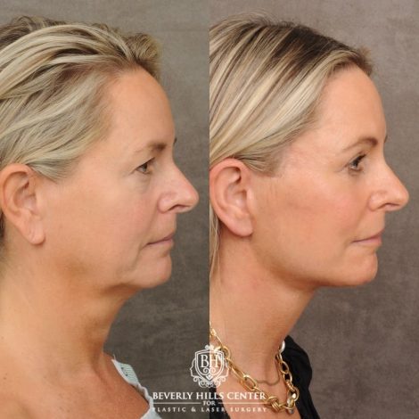 Beverly Hills Center Female Patient Before and After AuraLyft, Cupid Lift® Corner Lift, Upper & Lower Blepharoplasty, Temporal Brow Reset, Fat Grafting, Earlobe Reduction