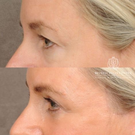 Beverly Hills Center Female Patient Before and After AuraLyft, Cupid Lift® Corner Lift, Upper & Lower Blepharoplasty, Temporal Brow Reset, Fat Grafting, Earlobe Reduction