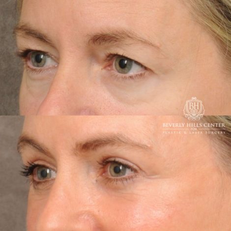 Beverly Hills Center Female Patient Before and After AuraLyft, Cupid Lift® Corner Lift, Upper & Lower Blepharoplasty, Temporal Brow Reset, Fat Grafting, Earlobe Reduction