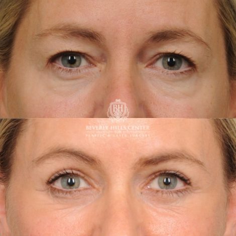 Beverly Hills Center Female Patient Before and After AuraLyft, Cupid Lift® Corner Lift, Upper & Lower Blepharoplasty, Temporal Brow Reset, Fat Grafting, Earlobe Reduction