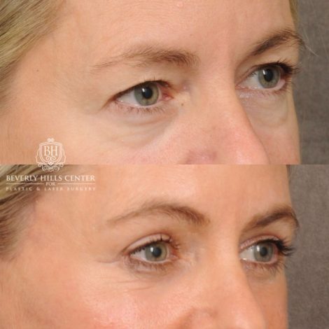 Beverly Hills Center Female Patient Before and After AuraLyft, Cupid Lift® Corner Lift, Upper & Lower Blepharoplasty, Temporal Brow Reset, Fat Grafting, Earlobe Reduction