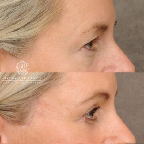 Beverly Hills Center Female Patient Before and After AuraLyft, Cupid Lift® Corner Lift, Upper & Lower Blepharoplasty, Temporal Brow Reset, Fat Grafting, Earlobe Reduction