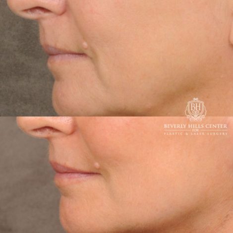 Beverly Hills Center Female Patient Before and After AuraLyft, Cupid Lift® Corner Lift, Upper & Lower Blepharoplasty, Temporal Brow Reset, Fat Grafting, Earlobe Reduction