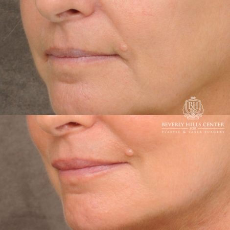 Beverly Hills Center Female Patient Before and After AuraLyft, Cupid Lift® Corner Lift, Upper & Lower Blepharoplasty, Temporal Brow Reset, Fat Grafting, Earlobe Reduction