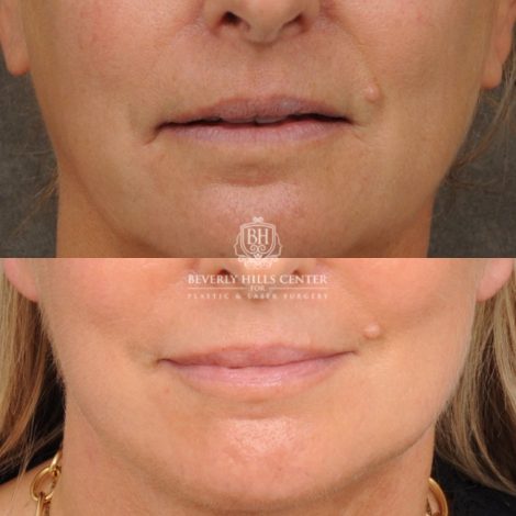 Beverly Hills Center Female Patient Before and After AuraLyft, Cupid Lift® Corner Lift, Upper & Lower Blepharoplasty, Temporal Brow Reset, Fat Grafting, Earlobe Reduction