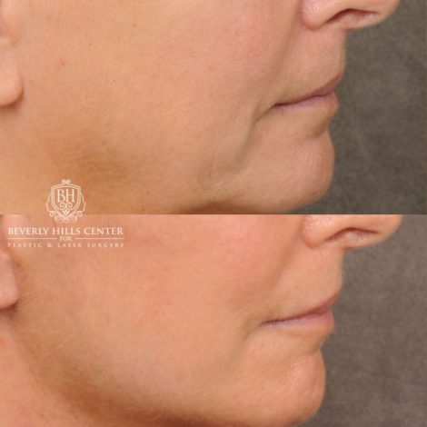 Beverly Hills Center Female Patient Before and After AuraLyft, Cupid Lift® Corner Lift, Upper & Lower Blepharoplasty, Temporal Brow Reset, Fat Grafting, Earlobe Reduction