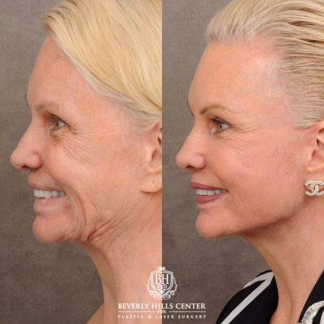 Beverly Hills Center Female Patient Before and After AuraLyft™, Upper & Lower Blepharoplasty, PHAT Face, and Fat Grafting