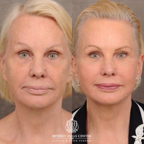 Beverly Hills Center Female Patient Before and After AuraLyft™, Upper & Lower Blepharoplasty, PHAT Face, and Fat Grafting