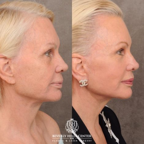 Beverly Hills Center Female Patient Before and After AuraLyft™, Upper & Lower Blepharoplasty, PHAT Face, and Fat Grafting