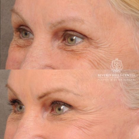 Beverly Hills Center Female Patient Before and After AuraLyft™, Upper & Lower Blepharoplasty, PHAT Face, and Fat Grafting