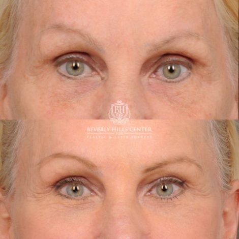 Beverly Hills Center Female Patient Before and After AuraLyft™, Upper & Lower Blepharoplasty, PHAT Face, and Fat Grafting