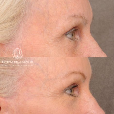Beverly Hills Center Female Patient Before and After AuraLyft™, Upper & Lower Blepharoplasty, PHAT Face, and Fat Grafting