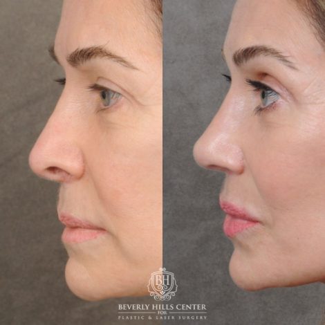 Beverly Hills Center Female Patient Before and After AuraLyft™ & Temporal Brow Reset