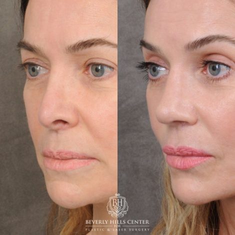 Beverly Hills Center Female Patient Before and After AuraLyft™ & Temporal Brow Reset