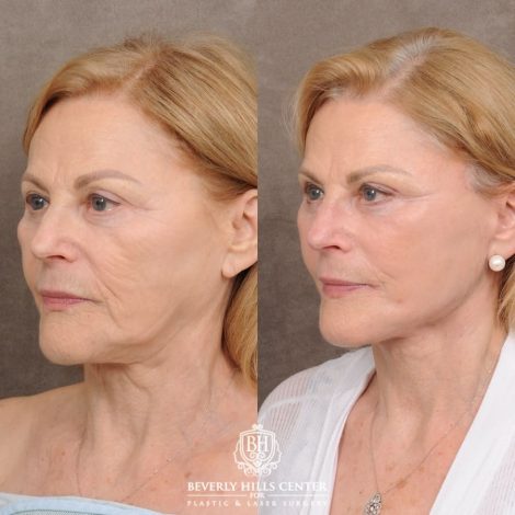Beverly Hills Center Female Patient Before and After AuraLyft™ & Temporal Brow Reset