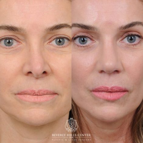 Beverly Hills Center Female Patient Before and After AuraLyft™ & Temporal Brow Reset