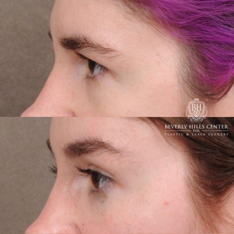 Beverly Hills Center Female Patient Before and After Temporal Brow Reset, Fat Grafting, Profound RF