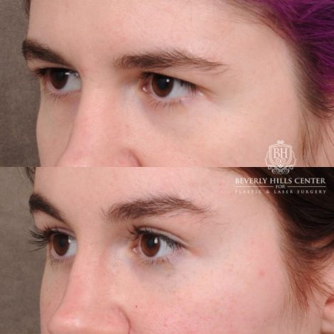 Beverly Hills Center Female Patient Before and After Temporal Brow Reset, Fat Grafting, Profound RF