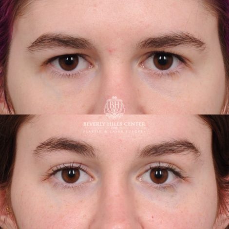 Beverly Hills Center Female Patient Before and After Temporal Brow Reset, Fat Grafting, Profound RF