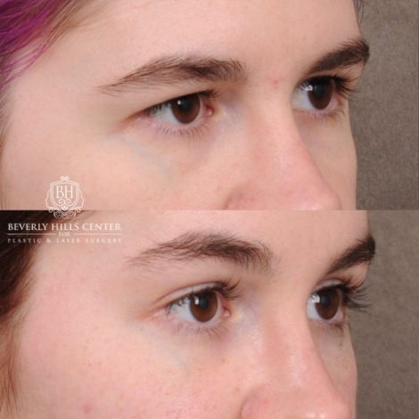 Beverly Hills Center Female Patient Before and After Temporal Brow Reset, Fat Grafting, Profound RF