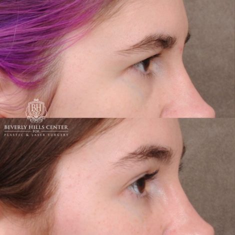 Beverly Hills Center Female Patient Before and After Temporal Brow Reset, Fat Grafting, Profound RF