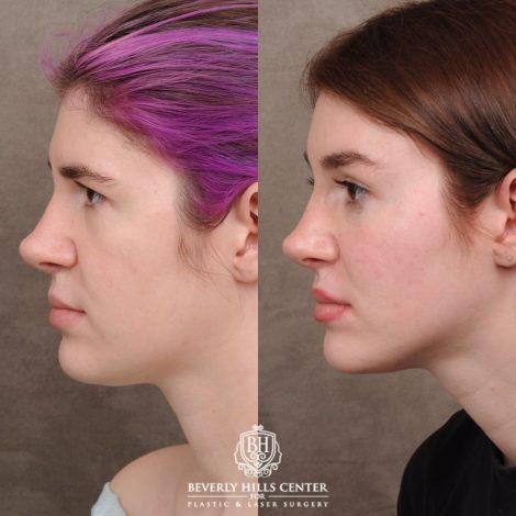 Beverly Hills Center Female Patient Before and After Temporal Brow Reset, Fat Grafting, Profound RF