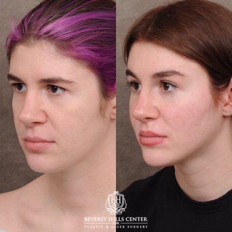 Beverly Hills Center Female Patient Before and After Temporal Brow Reset, Fat Grafting, Profound RF