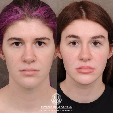 Beverly Hills Center Female Patient Before and After Temporal Brow Reset, Fat Grafting, Profound RF