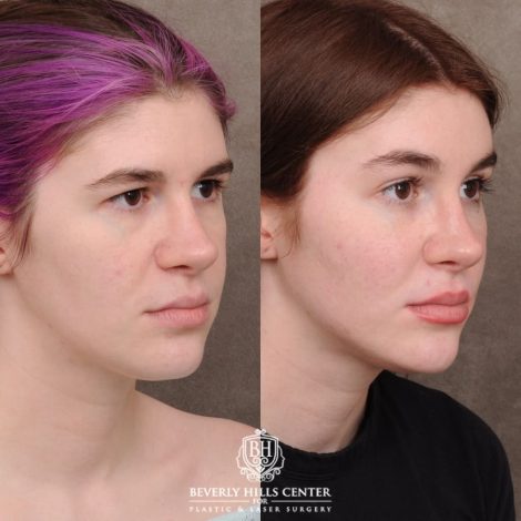 Beverly Hills Center Female Patient Before and After Temporal Brow Reset, Fat Grafting, Profound RF