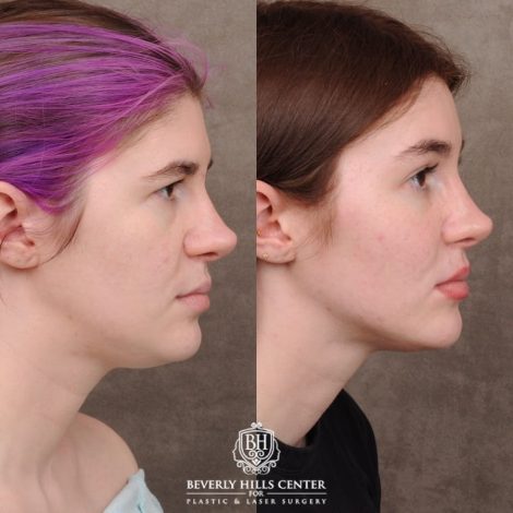 Beverly Hills Center Female Patient Before and After Temporal Brow Reset, Fat Grafting, Profound RF