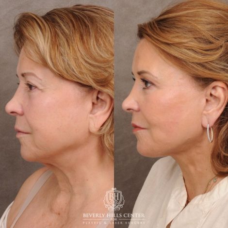 Beverly Hills Center Female Patient Before and After AuraLyft™, Temporal Brow Reset, Upper Blepharoplasty, PHAT Correction, Ptosis Repair