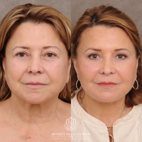 Beverly Hills Center Female Patient Before and After AuraLyft™, Temporal Brow Reset, Upper Blepharoplasty, PHAT Correction, Ptosis Repair