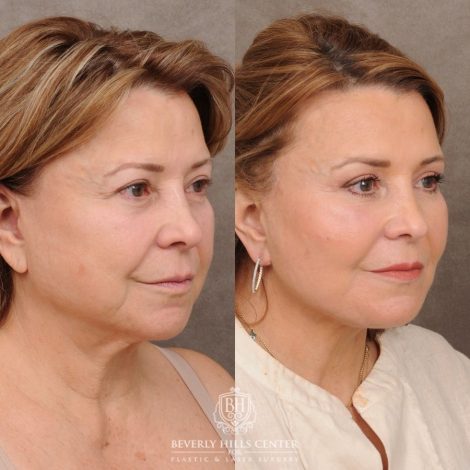 Beverly Hills Center Female Patient Before and After AuraLyft™, Temporal Brow Reset, Upper Blepharoplasty, PHAT Correction, Ptosis Repair