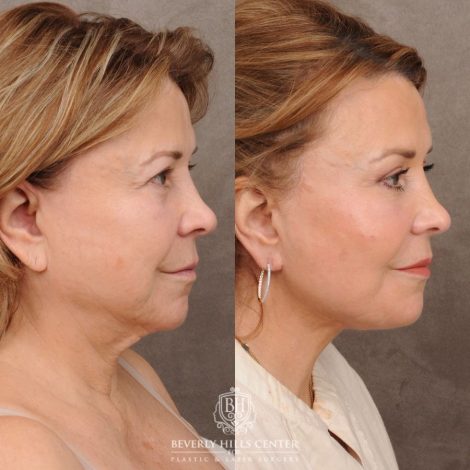 Beverly Hills Center Female Patient Before and After AuraLyft™, Temporal Brow Reset, Upper Blepharoplasty, PHAT Correction, Ptosis Repair
