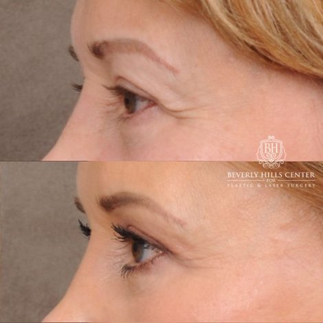 Beverly Hills Center Female Patient Before and After AuraLyft™, Temporal Brow Reset, Upper Blepharoplasty, PHAT Correction, Ptosis Repair