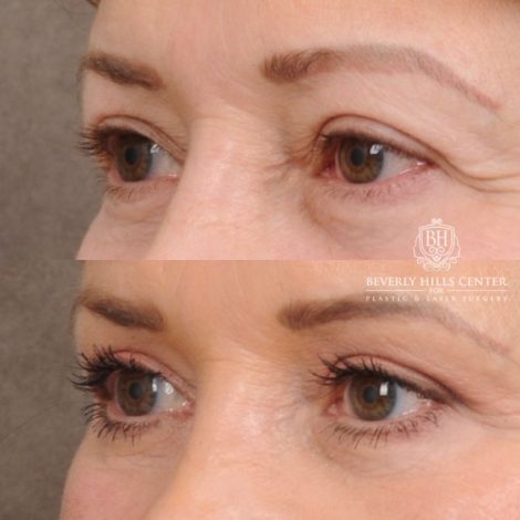 Beverly Hills Center Female Patient Before and After AuraLyft™, Temporal Brow Reset, Upper Blepharoplasty, PHAT Correction, Ptosis Repair