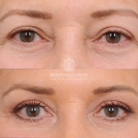 Beverly Hills Center Female Patient Before and After AuraLyft™, Temporal Brow Reset, Upper Blepharoplasty, PHAT Correction, Ptosis Repair