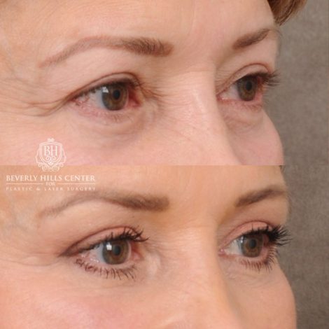Beverly Hills Center Female Patient Before and After AuraLyft™, Temporal Brow Reset, Upper Blepharoplasty, PHAT Correction, Ptosis Repair