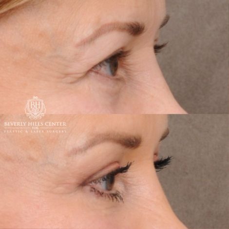 Beverly Hills Center Female Patient Before and After AuraLyft™, Temporal Brow Reset, Upper Blepharoplasty, PHAT Correction, Ptosis Repair