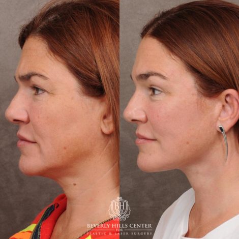 Beverly Hills Center Female Patient Before and After AuraLyft, Temporal Brow Reset, PHAT Face, TCA Lower Eyelids