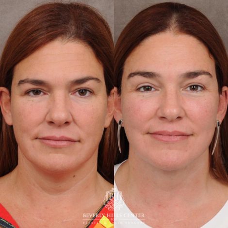 Beverly Hills Center Female Patient Before and After AuraLyft, Temporal Brow Reset, PHAT Face, TCA Lower Eyelids