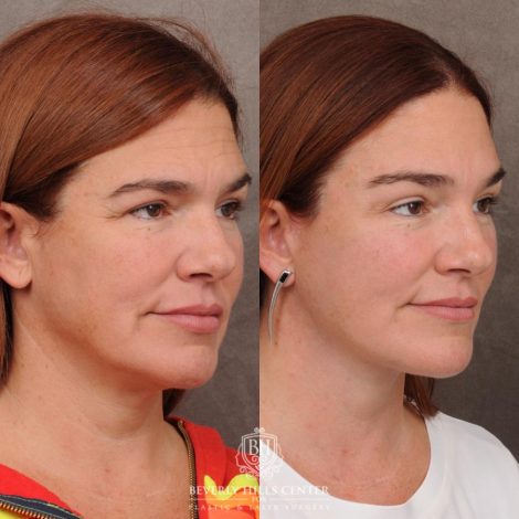 Beverly Hills Center Female Patient Before and After AuraLyft, Temporal Brow Reset, PHAT Face, TCA Lower Eyelids