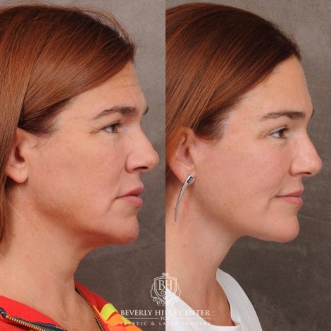 Beverly Hills Center Female Patient Before and After AuraLyft, Temporal Brow Reset, PHAT Face, TCA Lower Eyelids