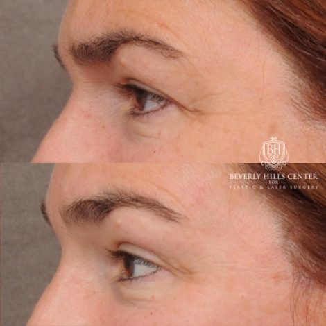 Beverly Hills Center Female Patient Before and After AuraLyft, Temporal Brow Reset, PHAT Face, TCA Lower Eyelids